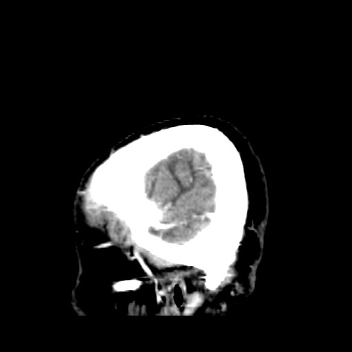 Brain metastasis (Radiopaedia 42617-45760 D 54).jpg