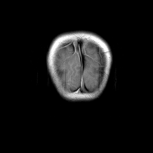 File:Brainstem ganglioglioma (Radiopaedia 10763-11224 Coronal T1 C+ 1).jpg