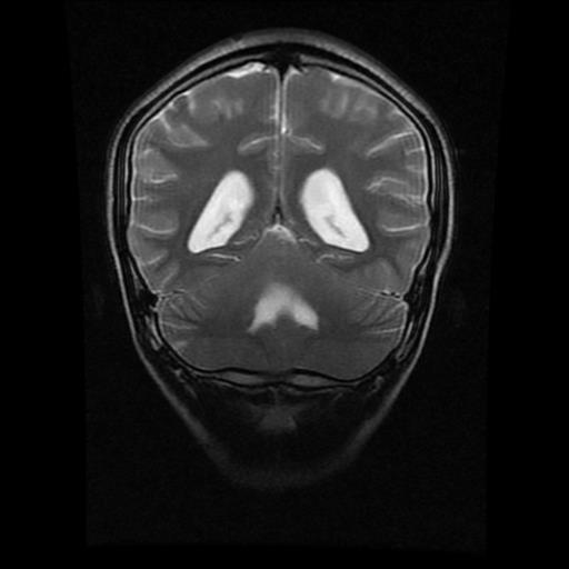 File:Brainstem glioma (Radiopaedia 30923-31624 Coronal T2 6).jpg