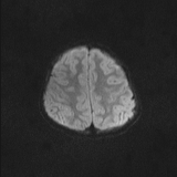 Brainstem glioma (Radiopaedia 67531-76922 Axial DWI 42).jpg