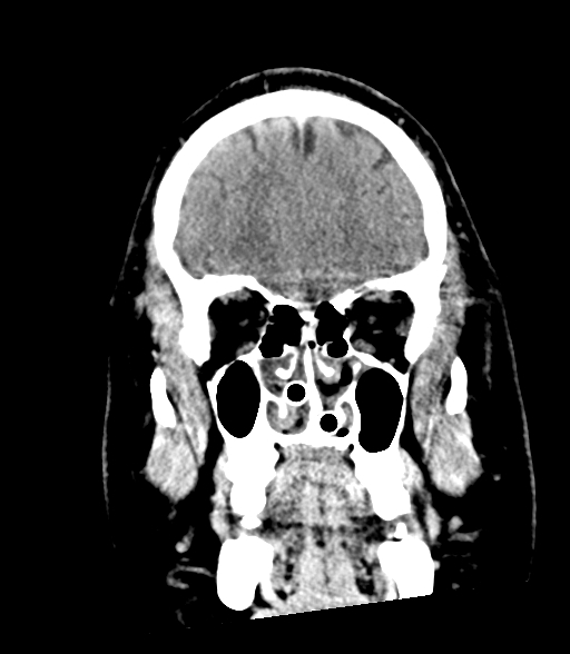 Brainstem hemorrhage (Radiopaedia 81294-94976 Coronal non-contrast 15).jpg