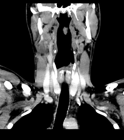 File:Branchial cleft cyst (Radiopaedia 31167-31875 Coronal C+ delayed 32).jpg