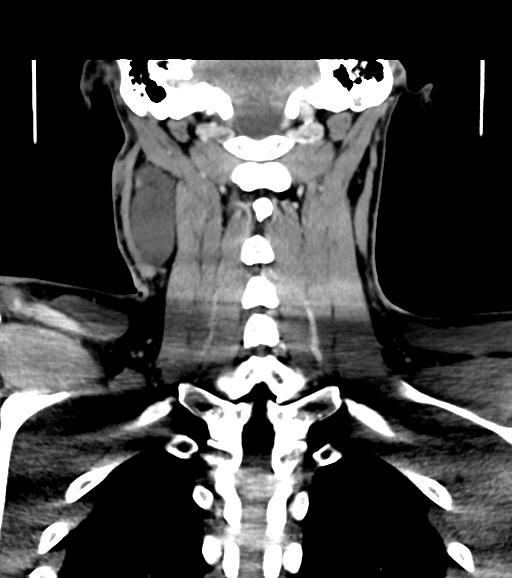 Branchial cleft cyst (Radiopaedia 31167-31875 Coronal C+ delayed 47).jpg