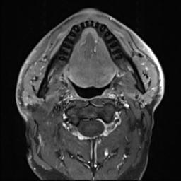 File:Branchial cleft cyst (Radiopaedia 31167-31876 Axial T1 C+ fat sat 18).jpg