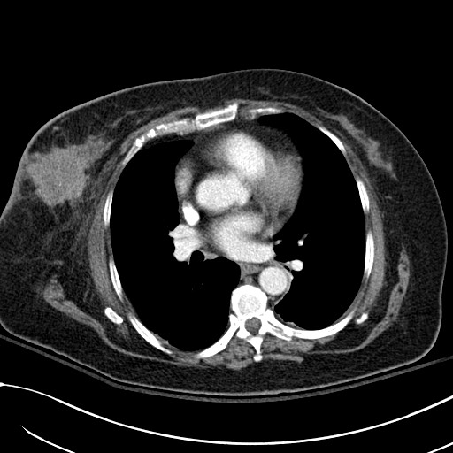 Breast carcinoma with pathological hip fracture (Radiopaedia 60314-67974 A 29).jpg