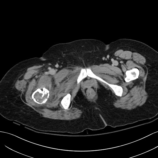 Breast carcinoma with pathological hip fracture (Radiopaedia 60314-67974 B 76).jpg