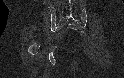 Breast carcinoma with pathological hip fracture (Radiopaedia 60314-67993 Coronal bone window 86).jpg