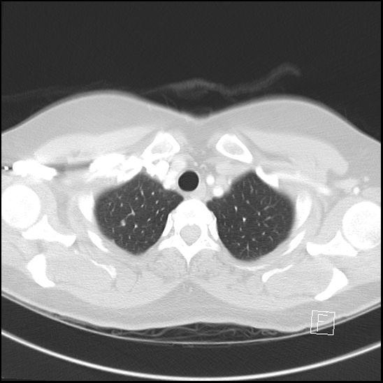 File:Breast metastases from renal cell cancer (Radiopaedia 79220-92225 Axial lung window 10).jpg