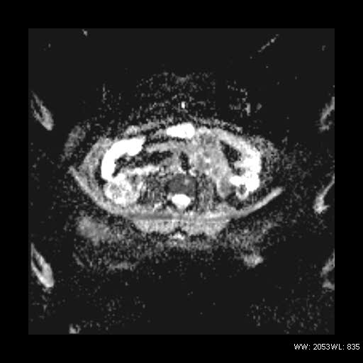 File:Broad ligament fibroid (Radiopaedia 49135-54241 Axial ADC 1).jpg