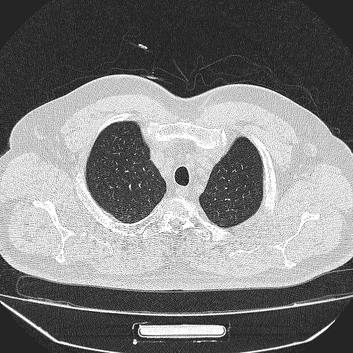 File:Bronchial atresia (Radiopaedia 58271-65417 Axial lung window 5).jpg