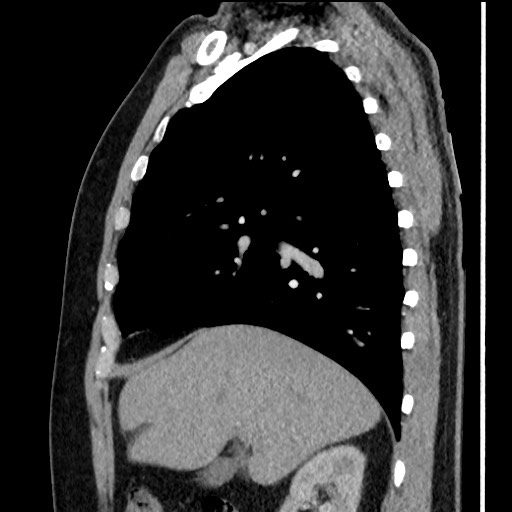 Bronchial carcinoid tumor (Radiopaedia 67377-76764 E 23).jpg
