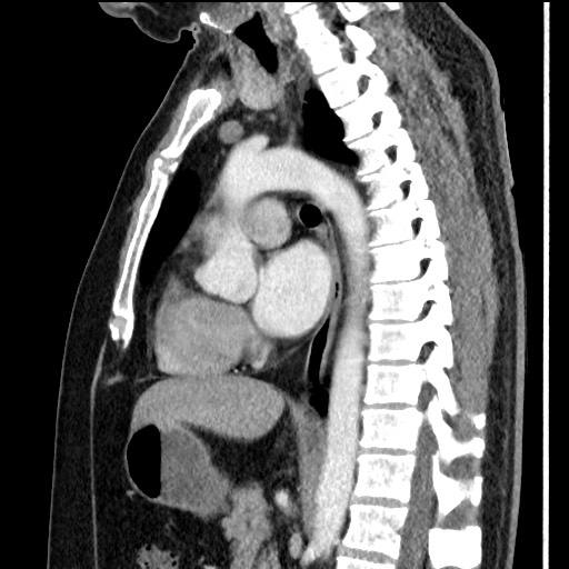 Bronchial carcinoid tumor (Radiopaedia 67377-76764 E 37).jpg