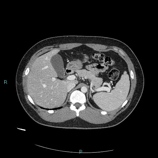 Bronchial carcinoid tumor (Radiopaedia 78272-90875 A 99).jpg