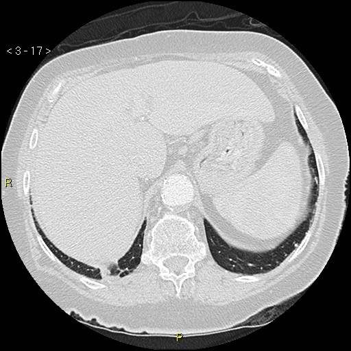 Bronchogenic carcinoma as an incidental finding (Radiopaedia 16453-16130 Axial lung window 17).jpg