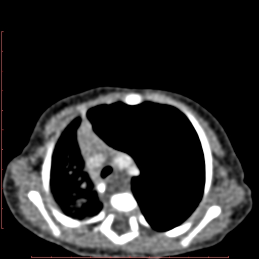 Bronchogenic cyst (Radiopaedia 78599-91409 B 74).jpg