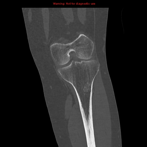 File:Brown tumors (Radiopaedia 9666-10291 Coronal bone window 18).jpg