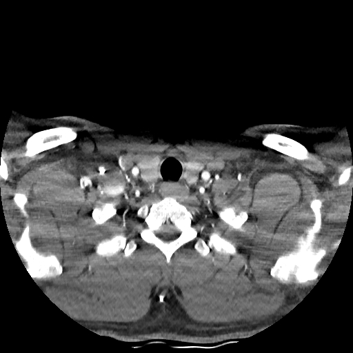 Buccal fat pad arteriovenous malformation (Radiopaedia 70936-81144 D 54).jpg