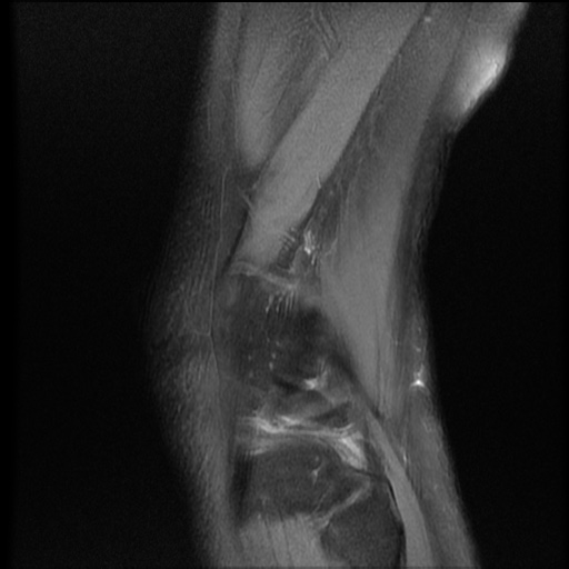 File:Bucket-handle meniscus tear (Radiopaedia 65700-74809 Sagittal PD fat sat 20).jpg