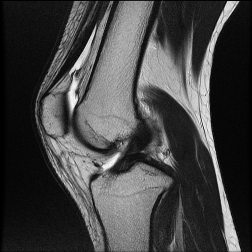 File:Bucket-handle meniscus tear (Radiopaedia 65700-74809 Sagittal T2 14).jpg