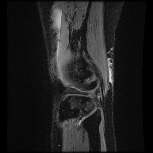 Bucket handle meniscus tear (Radiopaedia 56916-63751 H 8).jpg
