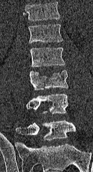 Burst fracture (Radiopaedia 53373-59357 Coronal bone window 38).jpg