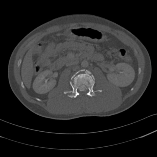 Burst fracture with cauda equina syndrome (Radiopaedia 25701-25867 Axial bone window 39).jpg