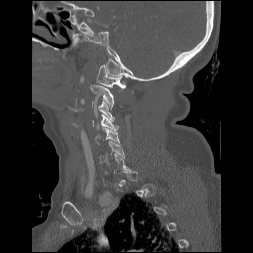 File:C1 anterior arch (plough) fracture - type 1 (Radiopaedia 76181-87720 Sagittal bone window 74).jpg