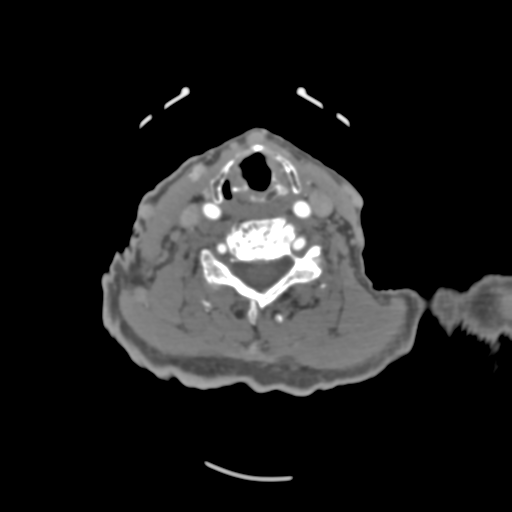 File:C2 fracture with vertebral artery dissection (Radiopaedia 37378-39200 A 111).png