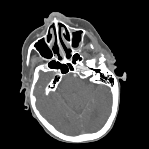 C2 fracture with vertebral artery dissection (Radiopaedia 37378-39200 A 216).png