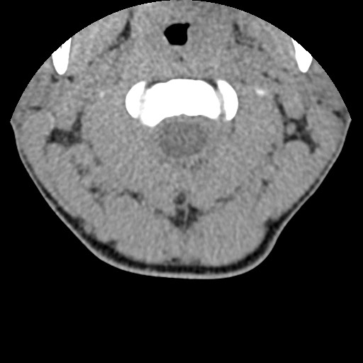 File:C5 facet fracture (Radiopaedia 58374-65499 Axial non-contrast 20).jpg