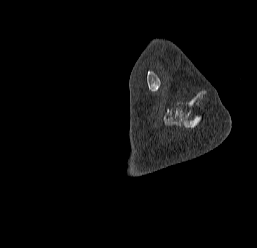 Calcaneal fracture - Sanders type 4 (Radiopaedia 90179-107370 Sagittal bone window 77).jpg