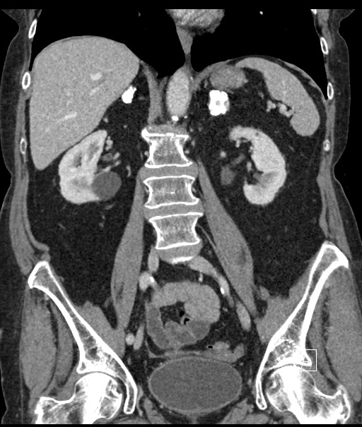 Calcified adrenal glands and Spigelian hernia (Radiopaedia 49741-54988 B 65).jpg