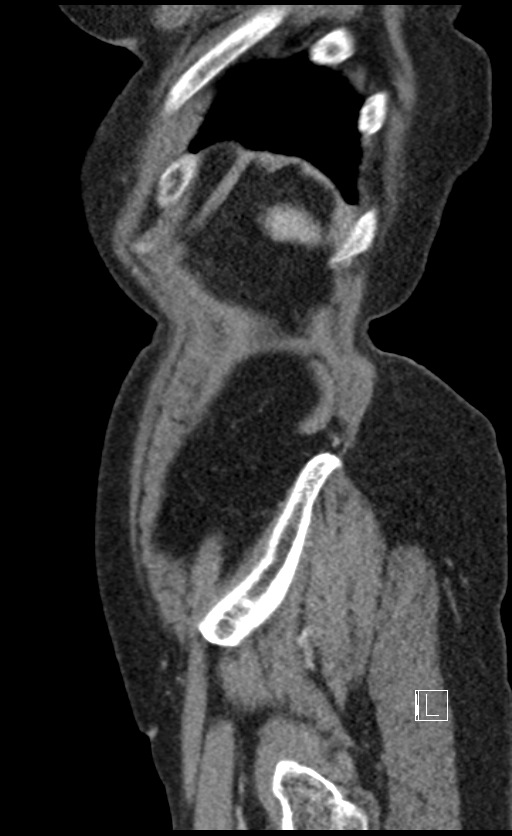 Calcified adrenal glands and Spigelian hernia (Radiopaedia 49741-54988 C 18).jpg