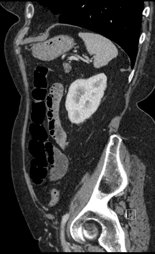 Calcified adrenal glands and Spigelian hernia (Radiopaedia 49741-54988 C 40).jpg