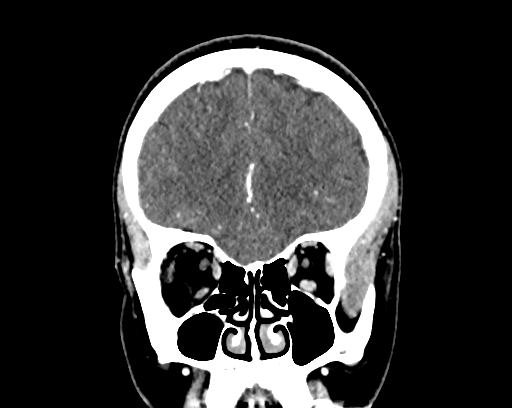 Calcified cerebral hydatid cyst (Radiopaedia 65603-74717 C 15).jpg