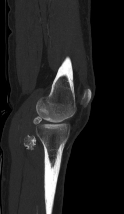 Calcified hematoma - popliteal fossa (Radiopaedia 63938-72763 D 7).jpg