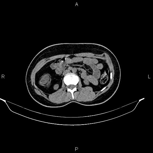 File:Calcified hepatic hydatid cyst (Radiopaedia 84672-100095 Axial non-contrast 49).jpg