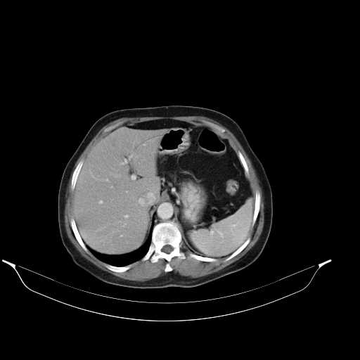 File:Calcified hydatid cyst of the liver (Radiopaedia 21212-21112 A 8).jpg