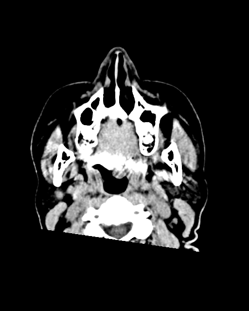 Calcified meningioma (Radiopaedia 74361-85243 Axial non-contrast 62).jpg