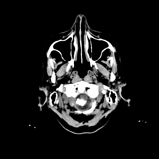 File:Calcified meningioma - cervical canal (Radiopaedia 70136-80171 Axial non-contrast 3).jpg