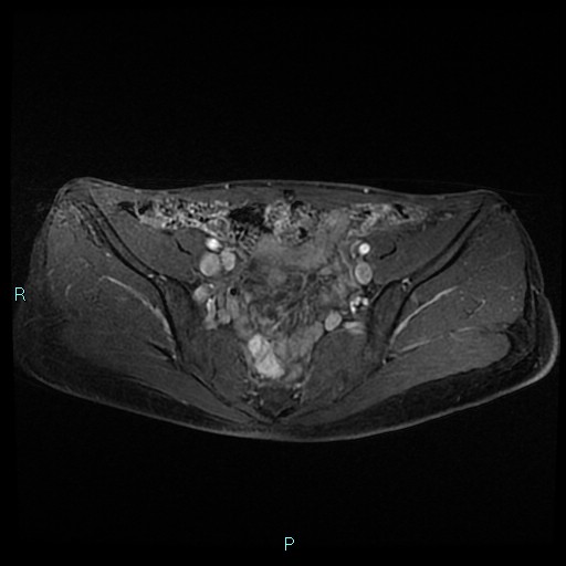 File:Canal of Nuck cyst (Radiopaedia 55074-61448 Axial T1 C+ fat sat 19).jpg