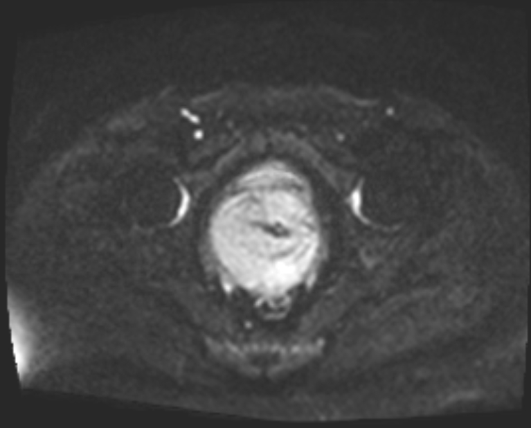 Cancer cervix - stage IIb (Radiopaedia 75411-86615 Axial DWI 41).jpg