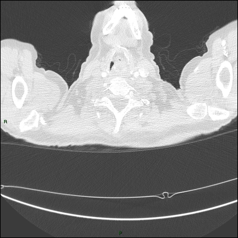 Cannonball metastases (Radiopaedia 82110-96150 Axial lung window 5).jpg