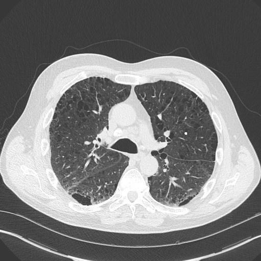 Caplan syndrome (Radiopaedia 56667-63530 Axial lung window 83).jpg