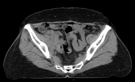 File:Carcinoma cervix - recurrence (Radiopaedia 34702-36137 Axial 11).png
