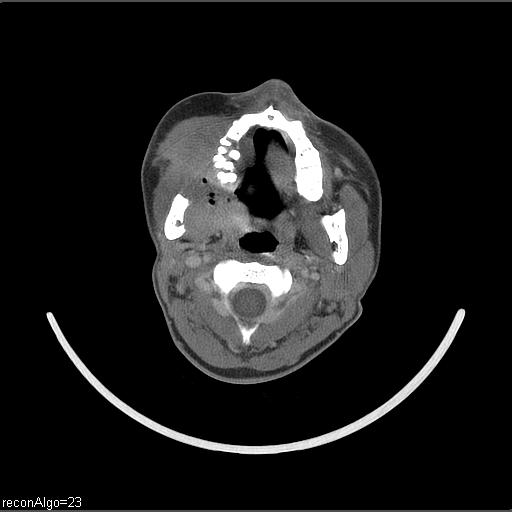 Carcinoma of the maxillary antrum (Radiopaedia 53805-59888 Axial C+ delayed 43).jpg