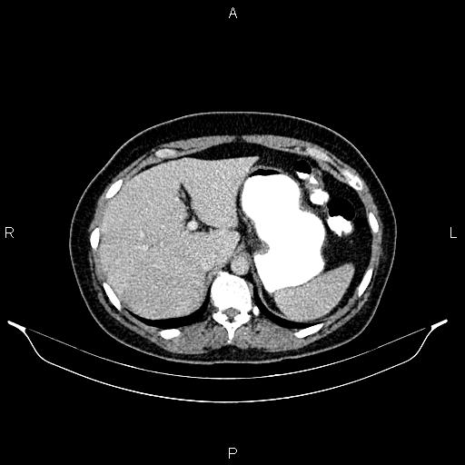 Carcinoma of uterine cervix (Radiopaedia 85861-101700 A 34).jpg