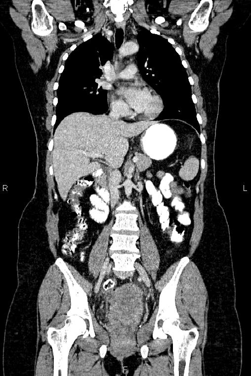 Carcinoma of uterine cervix (Radiopaedia 85861-101700 C 28).jpg