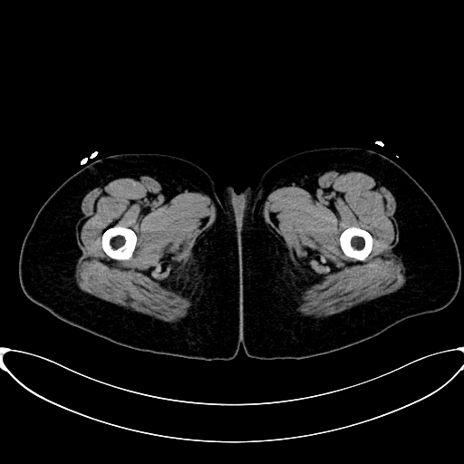 Caroli disease with medullary sponge kidney (Radiopaedia 82622-96804 Axial non-contrast 86).jpg