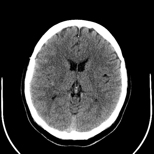File:Carotico ophthalmic aneurysm (Radiopaedia 42916-46147 Axial non-contrast 13).png